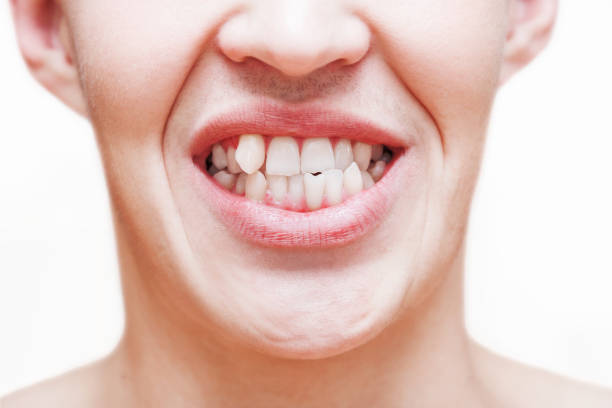 5 Reasons to Not Delay Treatment for Misaligned Teeth